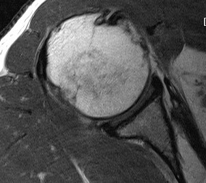 Subscapularis FT Tear MRI Glenoid Retraction